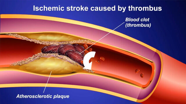 Bisa Bermata Dua, Membunuhmu Dalam 15 menit, Tapi Bisa Menyelamatkanmu dari Stroke