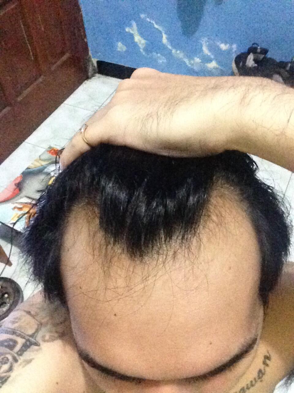 Rambut Gua Rontok Hampir Botak Page 81 KASKUS