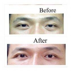 Operasi Blepharoplasty Agar Tidak Terlihat Lebih Tua