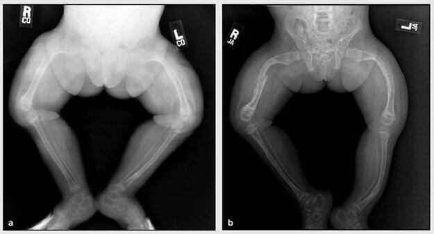 Mengenal Osteogenesis Imperfecta, Penyakit Fahri yang &quot;Setiap Batuk, Tulangnya Patah&quot;