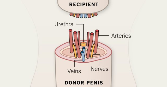Fakta Tentang Transplantasi Mr. P