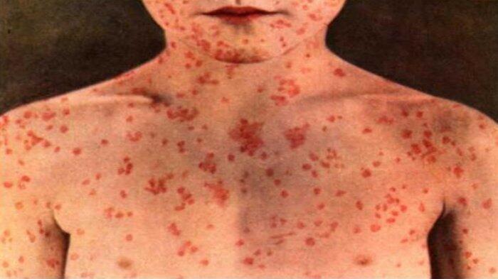 Virus Campak dari Indonesia Jadi Perhatian Besar, Menyebar di Jepang