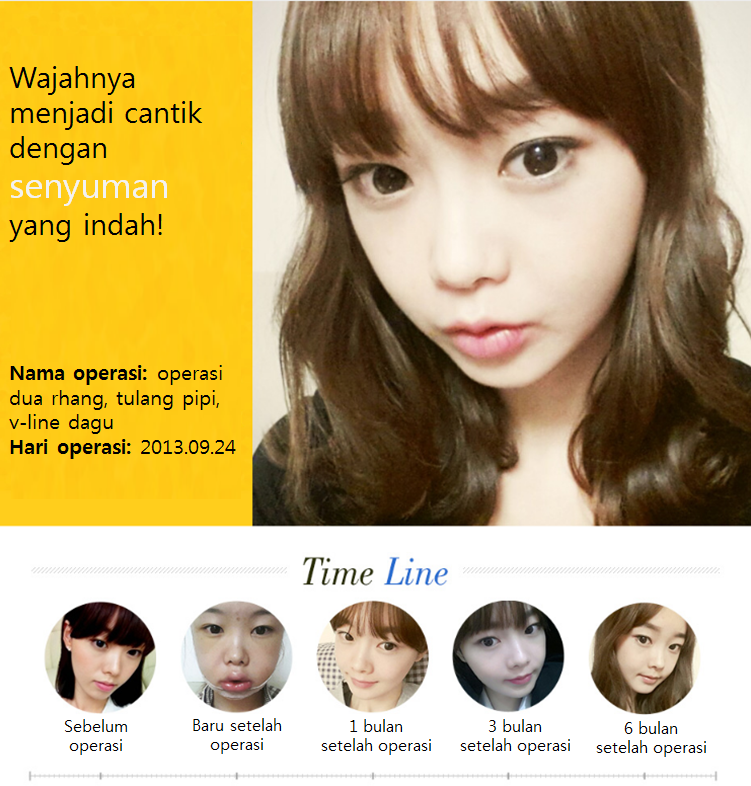 Pengalaman oplas di Korea: dua rahang, tulang pipi, v-line dagu review di REGEN