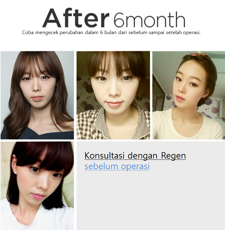 Pengalaman oplas di Korea: dua rahang, tulang pipi, v-line dagu review di REGEN