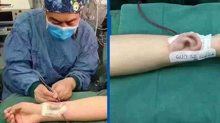 Dokter di China Sukses Tumbuhkan Telinga di Tangan Pasien