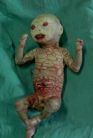 sakit genetik bernama ichthyosis jenis Harlequin.