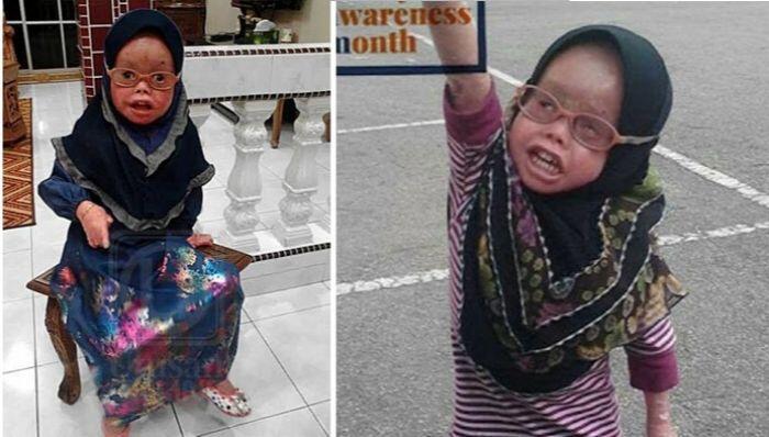 sakit genetik bernama ichthyosis jenis Harlequin.
