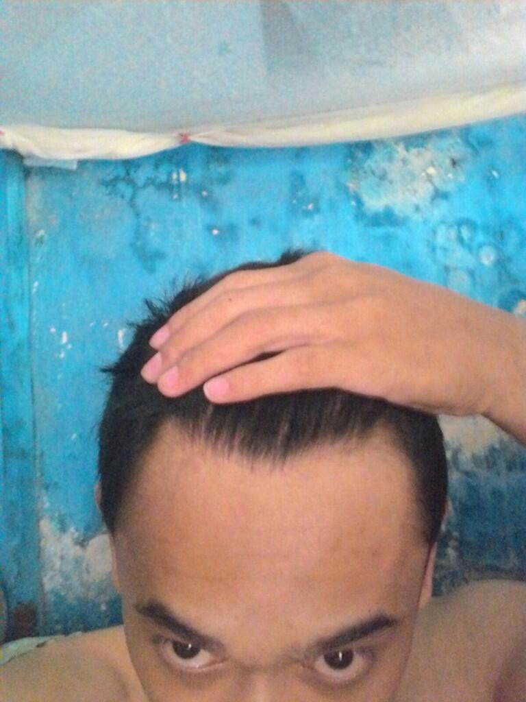 Rambut Gua Rontok Hampir Botak Page 94 KASKUS