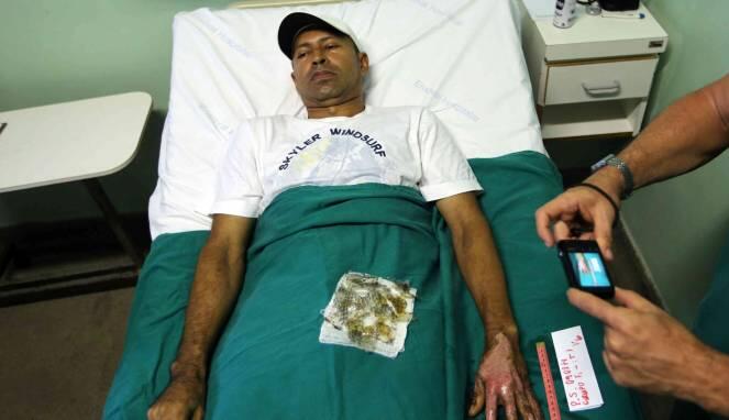 Tak Lazim, Kulit Ikan Nila Jadi Obat Luka Bakar