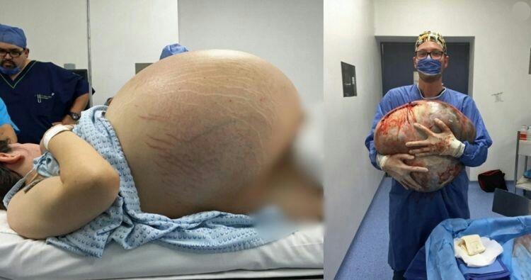 Kumpulan Foto ini tunjukan proses operasi kista sebesar 33 kg, menegangkan!