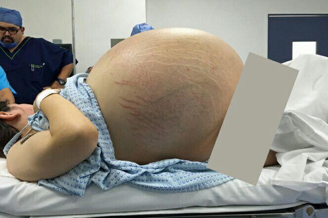 Kumpulan Foto ini tunjukan proses operasi kista sebesar 33 kg, menegangkan!