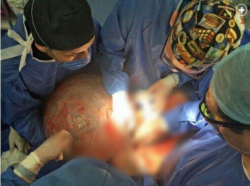 Kumpulan Foto ini tunjukan proses operasi kista sebesar 33 kg, menegangkan!