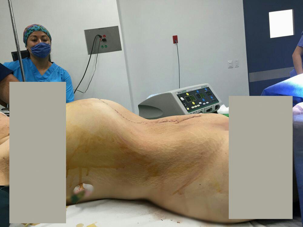 Kumpulan Foto ini tunjukan proses operasi kista sebesar 33 kg, menegangkan!