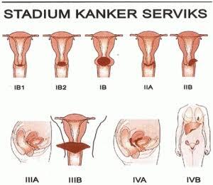 Mengenal Kanker Serviks, Penyakit Pembunuh Jupe