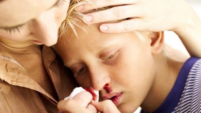 Kenali Tanda-Tanda Penyakit Leukimia yang Menyebabkan Ririn Ekawati Meninggal