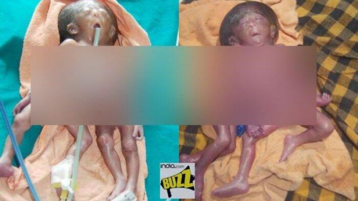 Warga India Dihebohkan Bayi Bertangan dan Berkaki Empat, Seperti Ini Rupanya