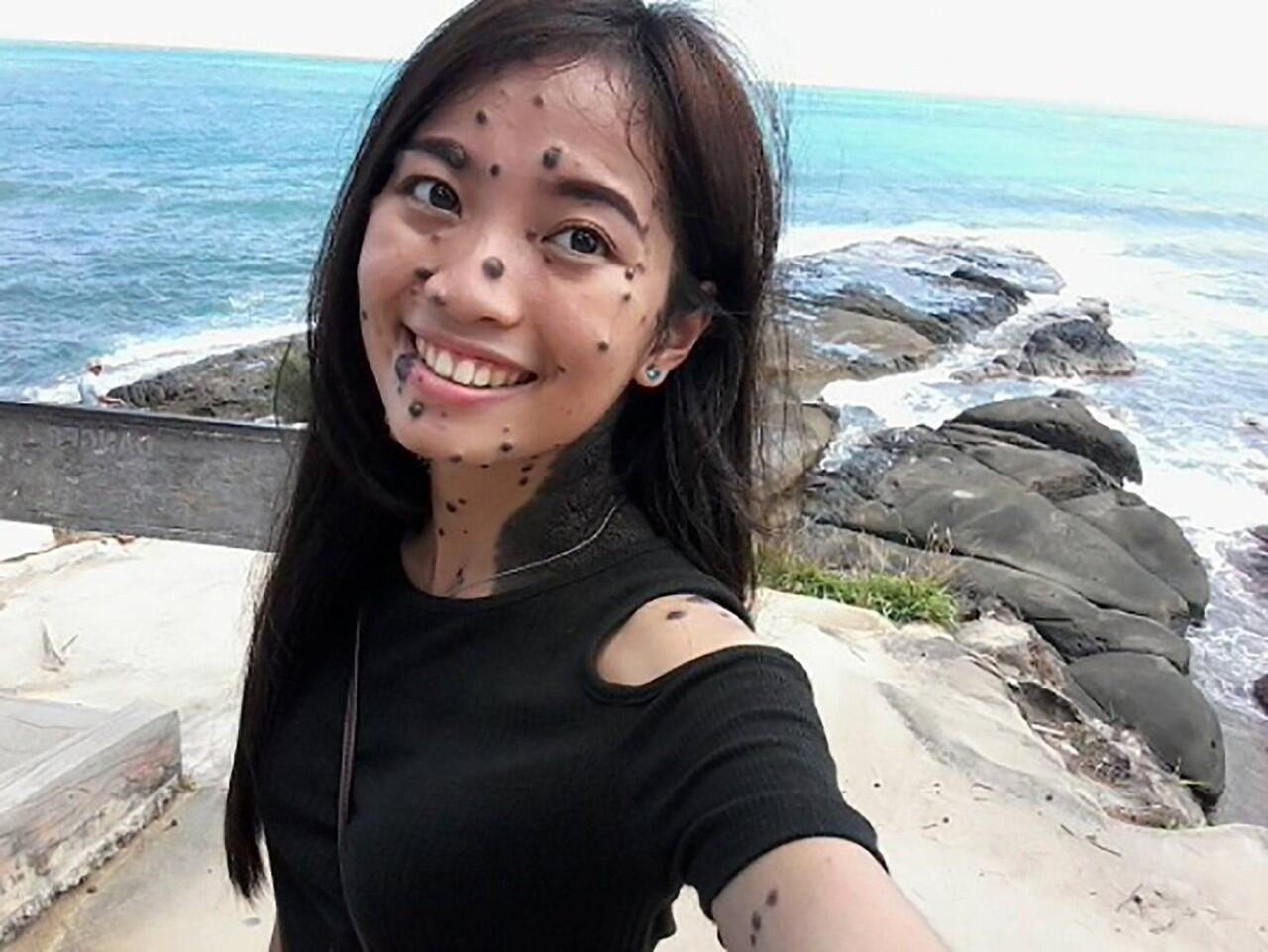 Dengan Tahi Lalat di Sekujur Tubuhnya, Cewek Ini PD Ikutan Miss Universe