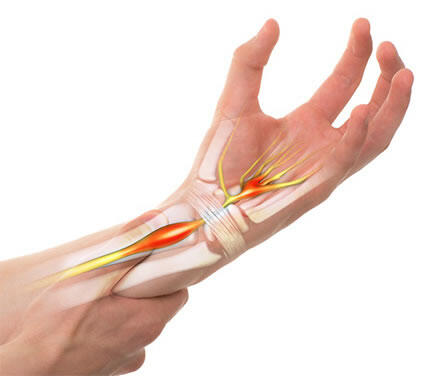 Carpal tunnel syndrome dan bagaimana cara mengobatinya.