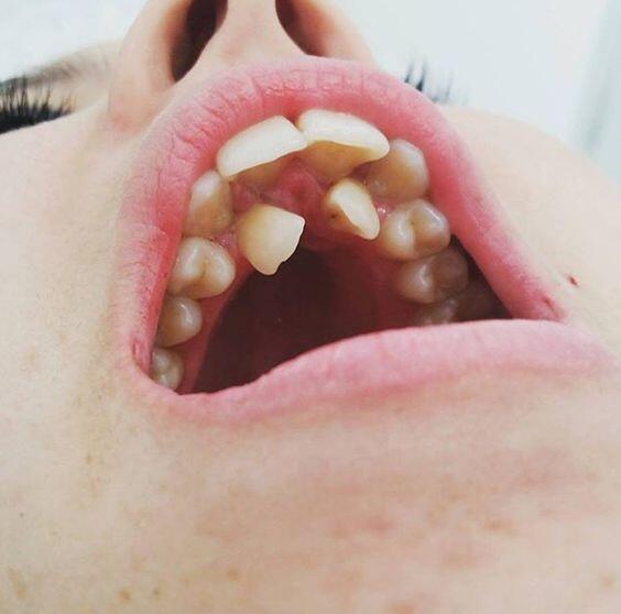 Kelainan Gigi Hyperdontia Ini Bakal Bikin Kamu Merinding! 