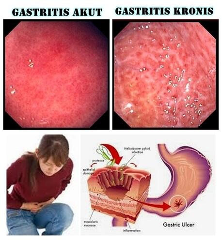 Gastritis akut