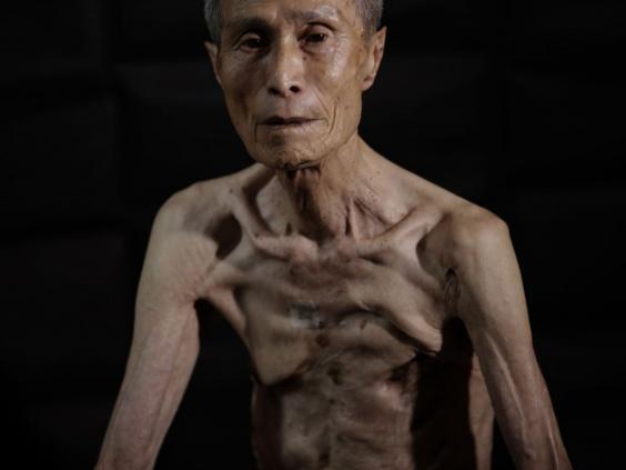 (Mengerikan) Inilah Foto Korban Bencana Nuklir