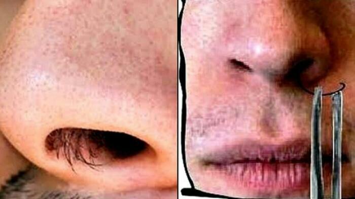 Sering Mencabut Bulu Hidung? Awas, Bahayanya yang Harus agan tau