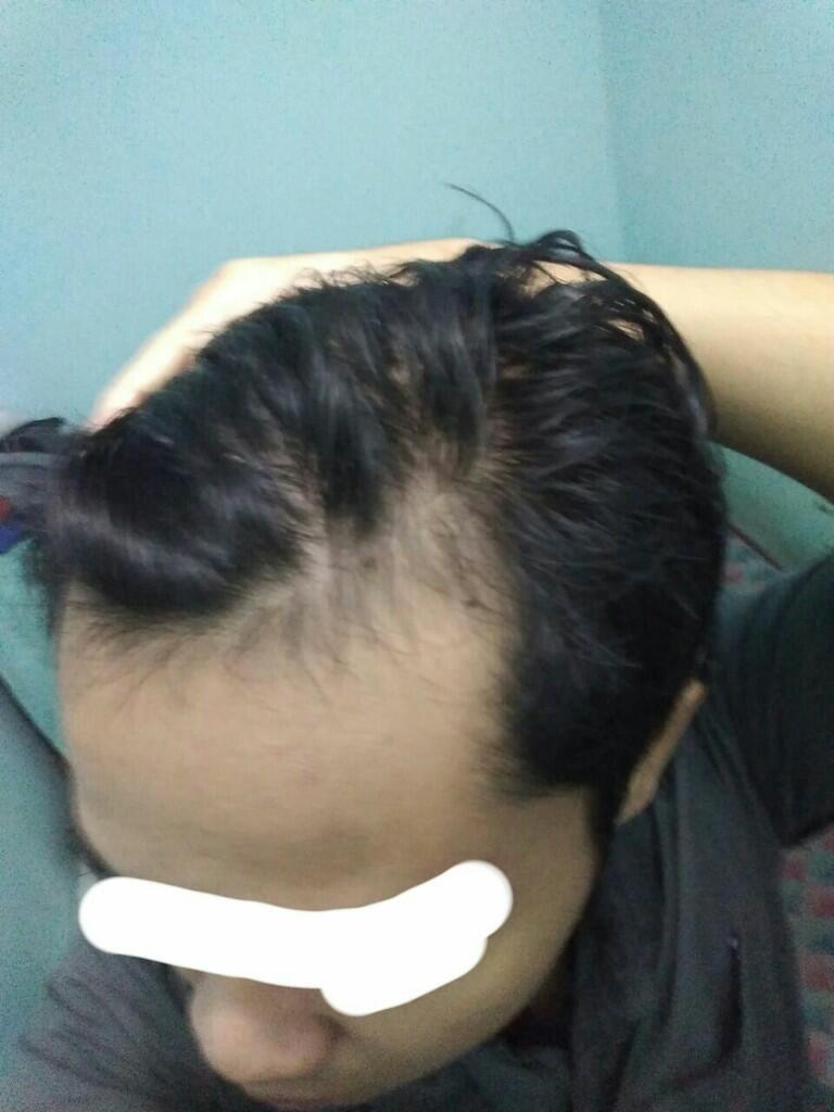 Rambut Gua Rontok Hampir Botak Page 126 KASKUS