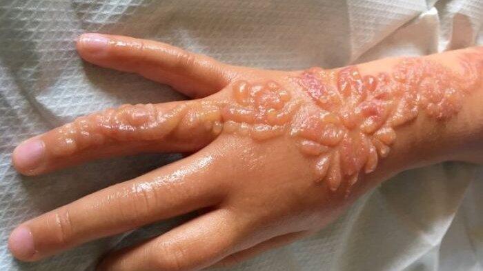 Bikin Tato Henna, Gadis Ini Akhirnya Menderita