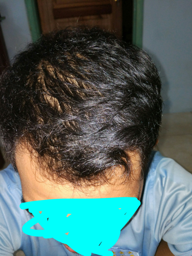 Rambut Gua Rontok Hampir Botak Page 132 KASKUS