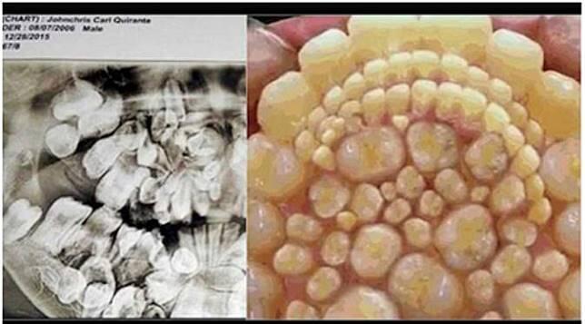 Sulit Dipercaya, Remaja ini Memiliki 232 Gigi di Mulutnya