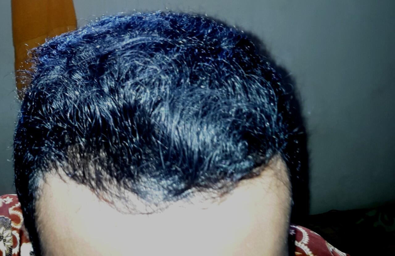 Rambut Gua Rontok Hampir Botak Page 132 KASKUS