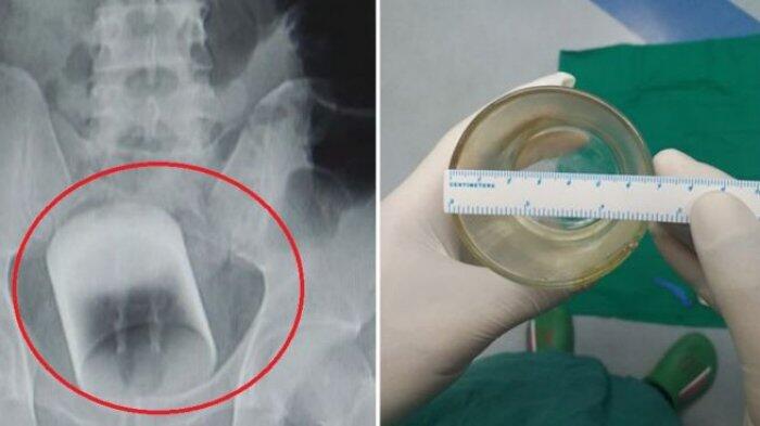 Ditemukan Gelas di Dalam Tubuh Pria ini, Kok bisa?