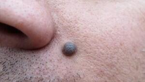 Kenapa bintik hitam di tubuh disebut "Tahi Lalat"