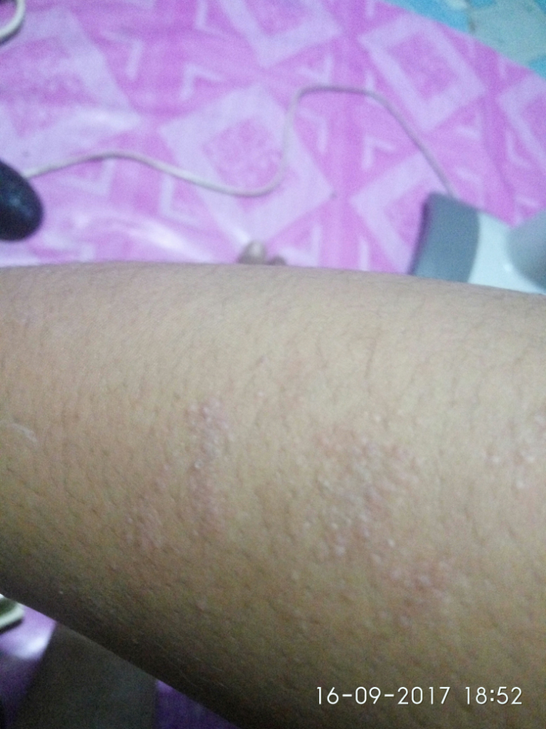 (ASK) Penyakit Kulit Jenis Apa Ya Ini???