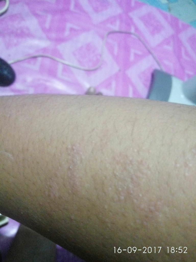 (ASK) Penyakit Kulit Jenis Apa Ya Ini???