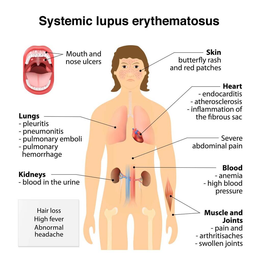 Mengenal Penyakit Lupus Yang Diderita Selena Gomez