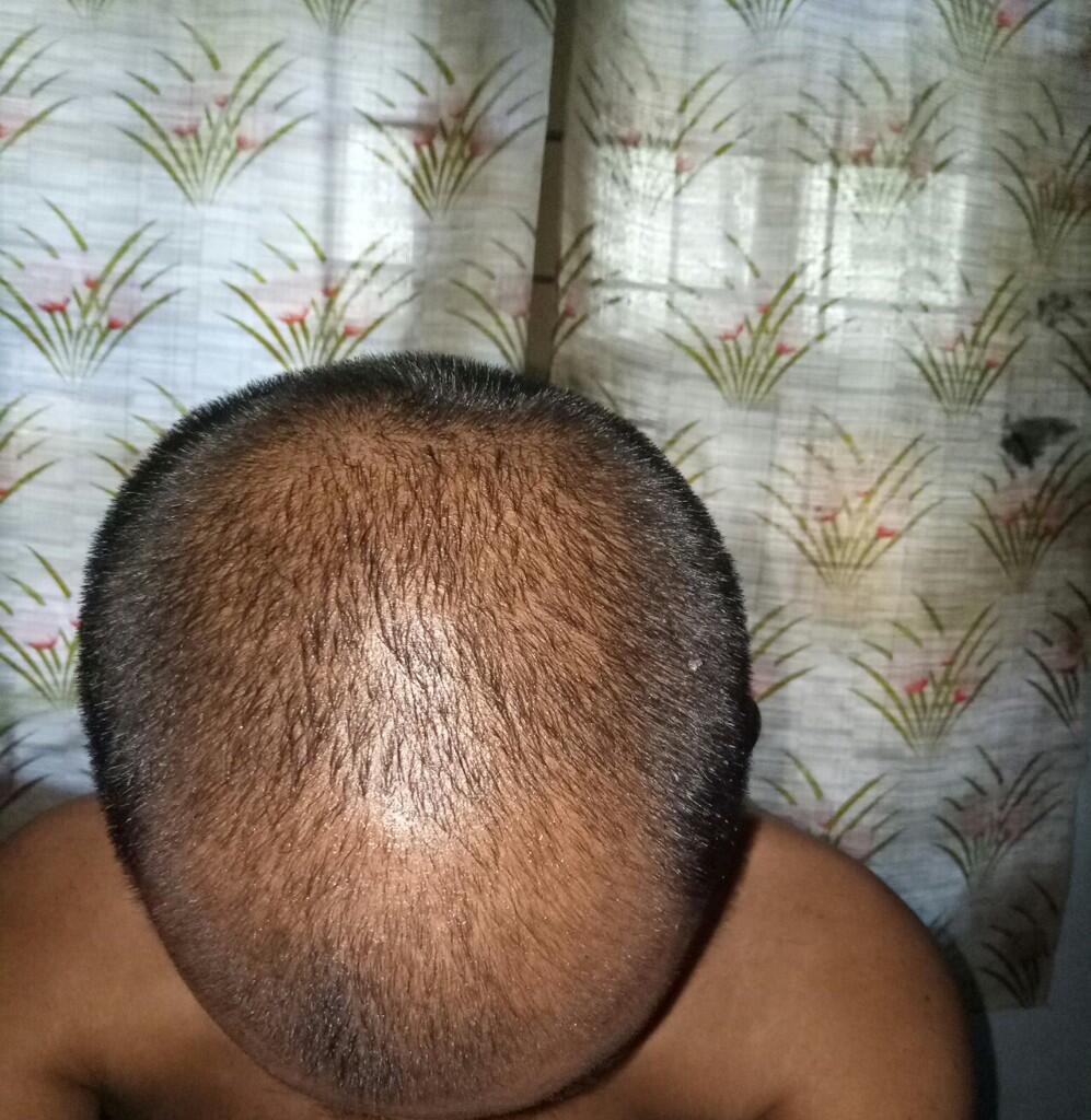 Rambut Gua Rontok Hampir Botak Page 138 KASKUS