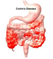 Penyakit Crohn; Kenali Lebih Dekat Sebelum Terlambat!