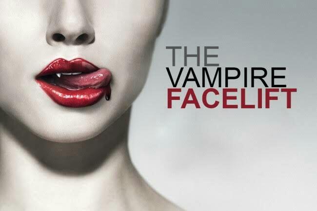 Mengenal Vampire Facelift, Perawatan Kulit Menggunakan Darah