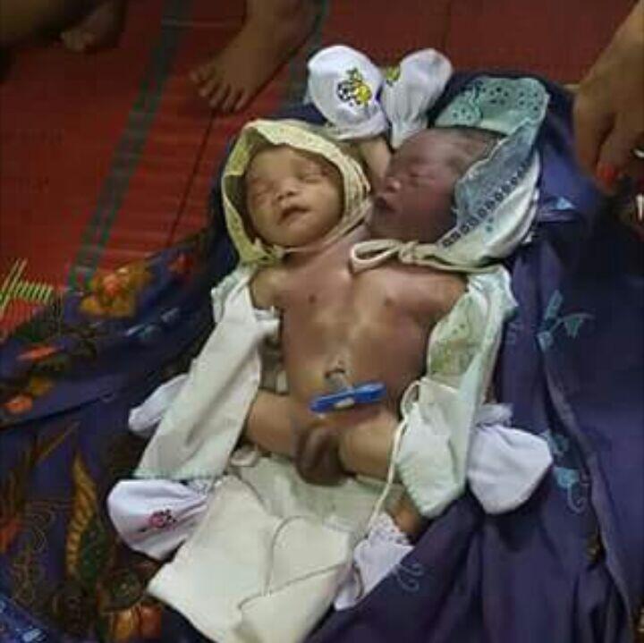 Bayi Dengan Dua Kepala Satu Badan Lahir Di Tapanuli Tengah