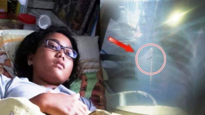 Ini 4 Fakta Siswi SMP Telan Jarum Pentul, Kronologi Sampai Wujud Jarum yang Berkarat