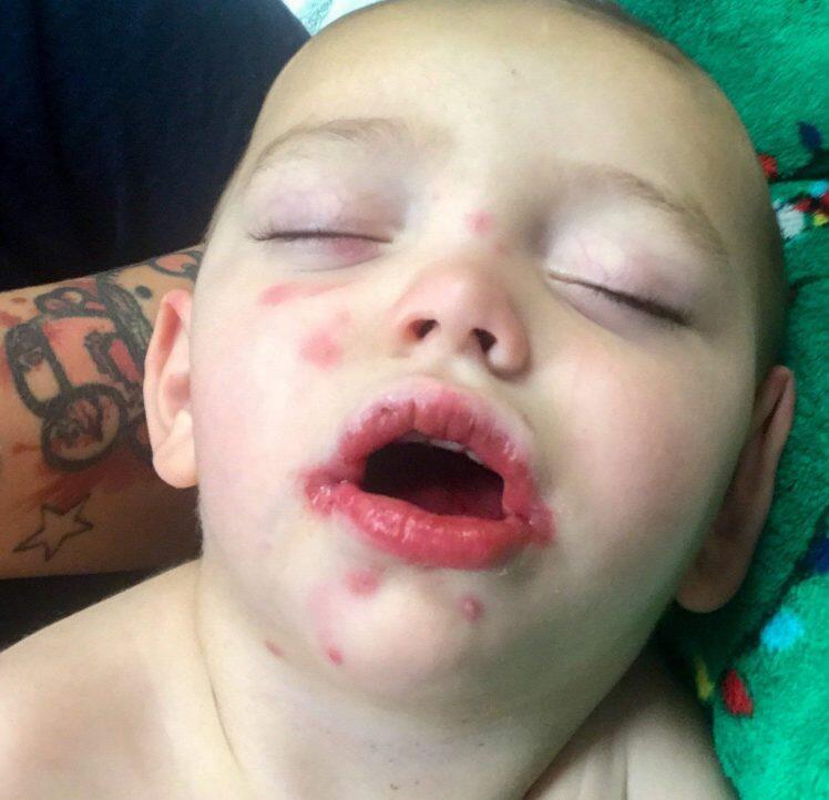 Baby left fighting for life after catching herpes from family friend