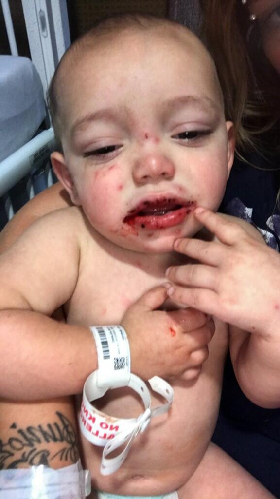 Baby left fighting for life after catching herpes from family friend