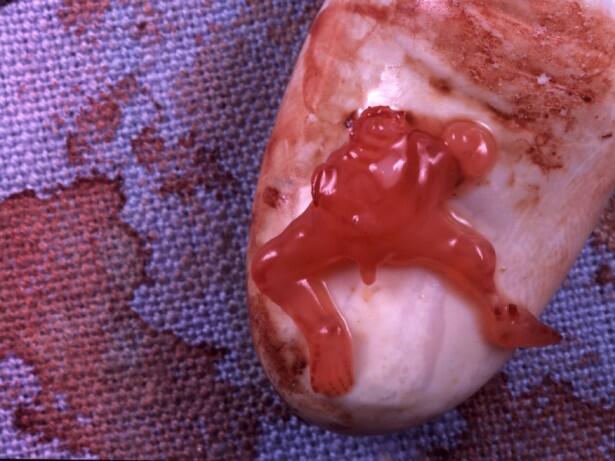 Stop Aborsi Pengertian, Akibat dan Hukumnya &#91;Disertai Foto Bayi Hasil Aborsi&#93;