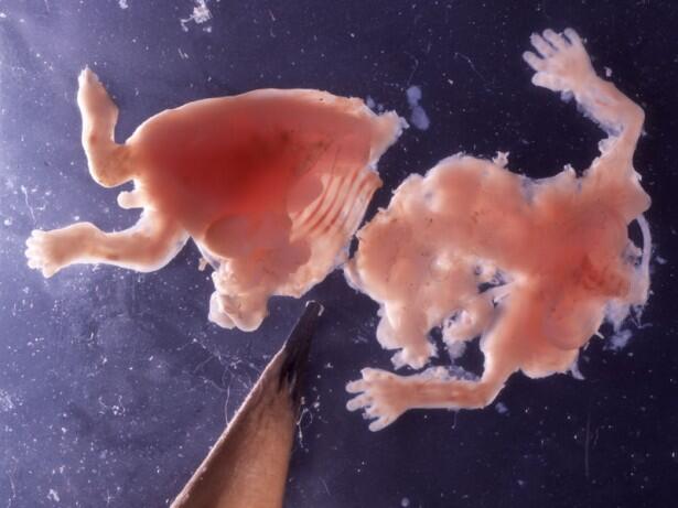 Stop Aborsi Pengertian, Akibat dan Hukumnya &#91;Disertai Foto Bayi Hasil Aborsi&#93;