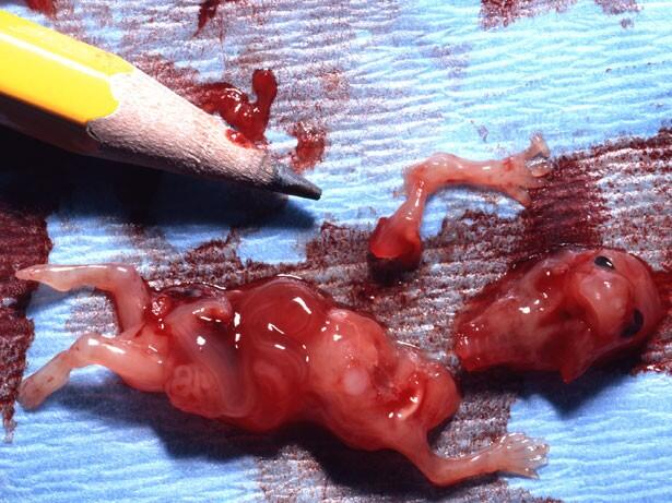 Stop Aborsi Pengertian, Akibat dan Hukumnya &#91;Disertai Foto Bayi Hasil Aborsi&#93;
