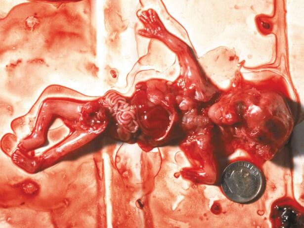Stop Aborsi Pengertian, Akibat dan Hukumnya &#91;Disertai Foto Bayi Hasil Aborsi&#93;