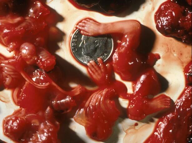 Stop Aborsi Pengertian, Akibat dan Hukumnya &#91;Disertai Foto Bayi Hasil Aborsi&#93;