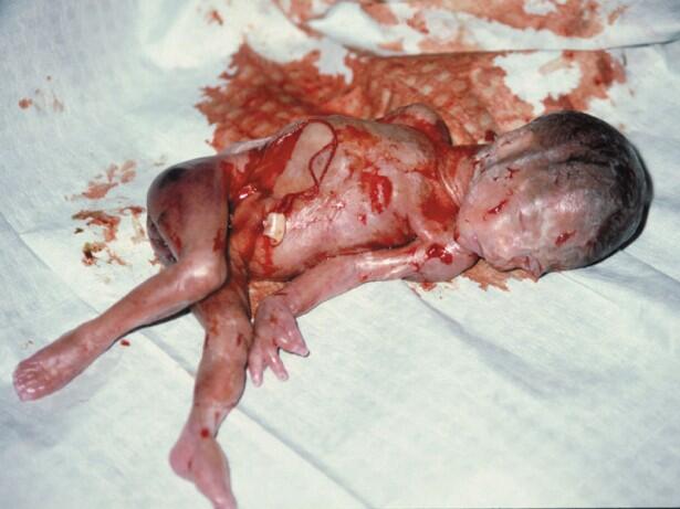 Stop Aborsi Pengertian, Akibat dan Hukumnya &#91;Disertai Foto Bayi Hasil Aborsi&#93;