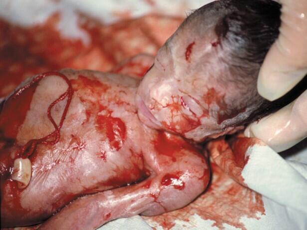 Stop Aborsi Pengertian, Akibat dan Hukumnya &#91;Disertai Foto Bayi Hasil Aborsi&#93;